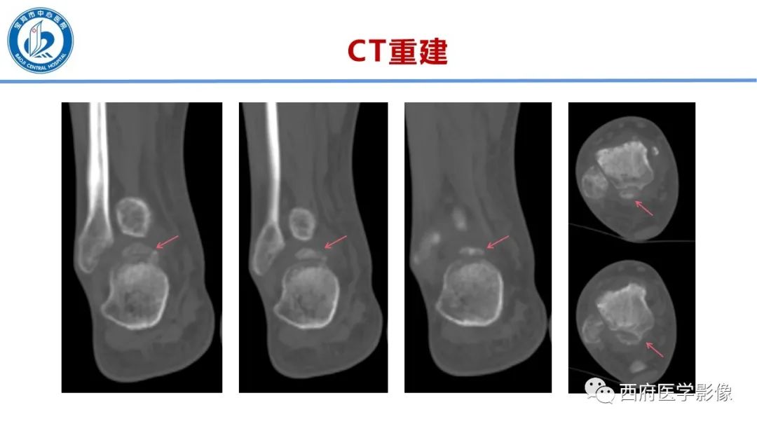 影像PPT - 【PPT】距后三角籽骨综合征影像诊断-15