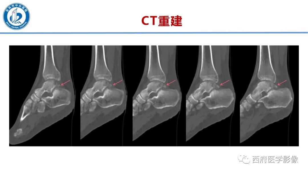 影像PPT - 【PPT】距后三角籽骨综合征影像诊断-14