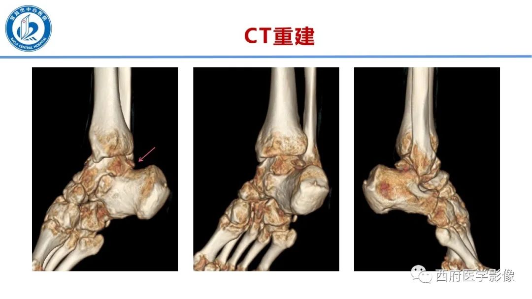 影像PPT - 【PPT】距后三角籽骨综合征影像诊断-16