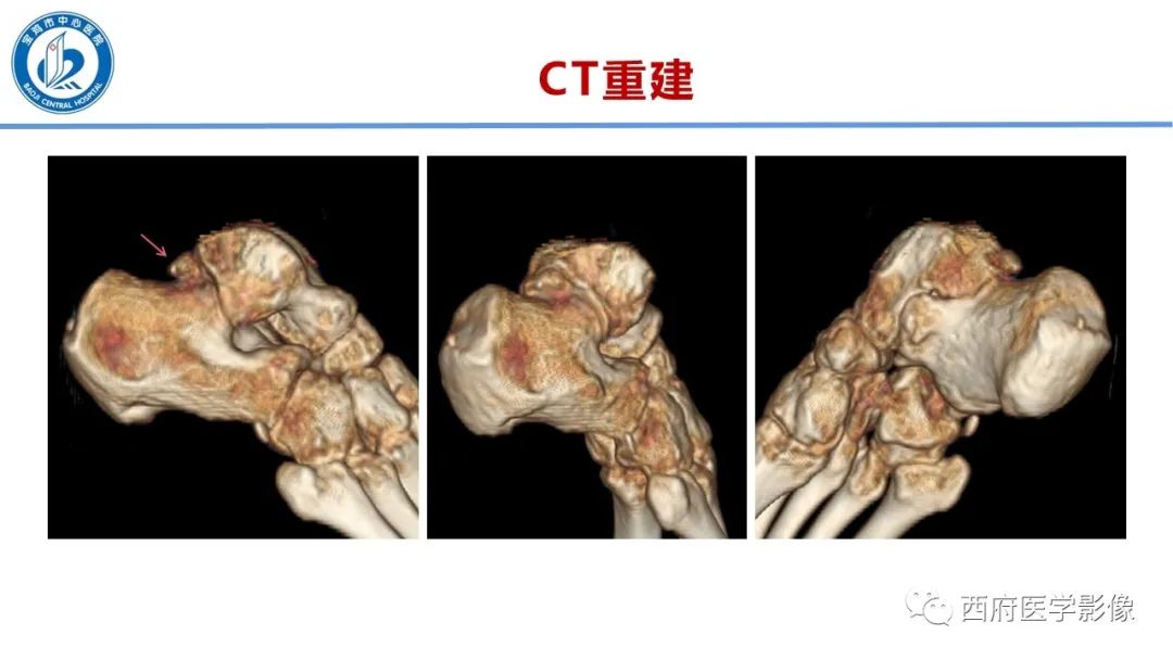 影像PPT - 【PPT】距后三角籽骨综合征影像诊断-17