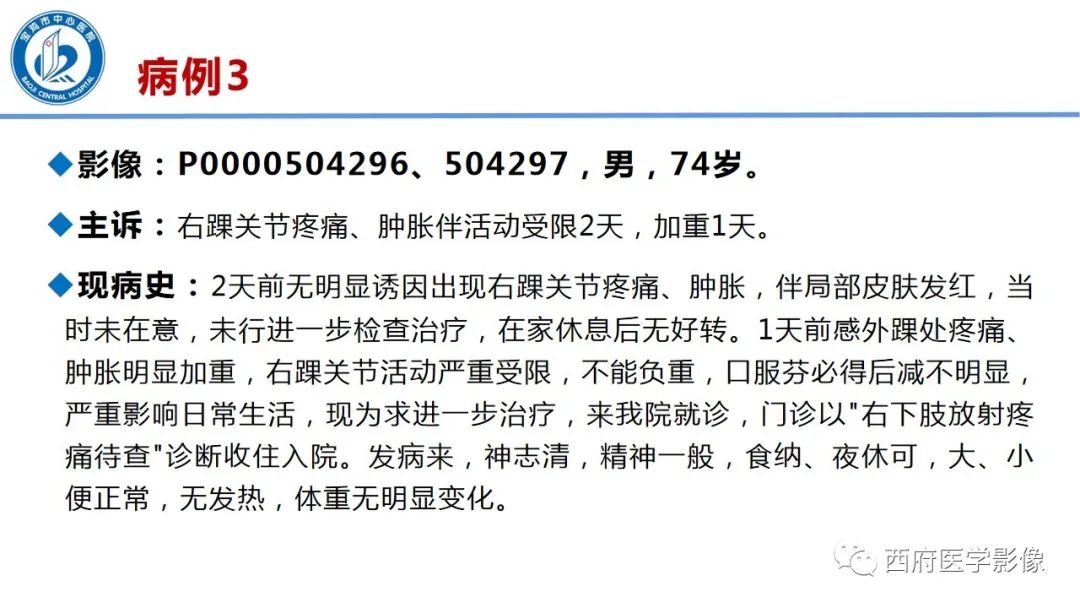 影像PPT - 【PPT】距后三角籽骨综合征影像诊断-23