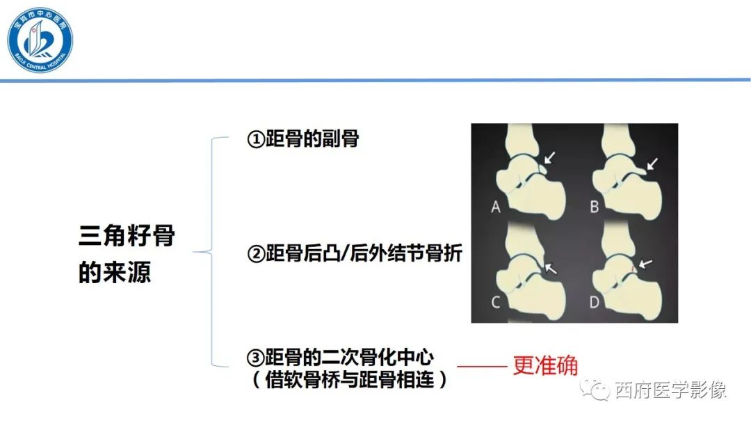 影像PPT - 【PPT】距后三角籽骨综合征影像诊断-29