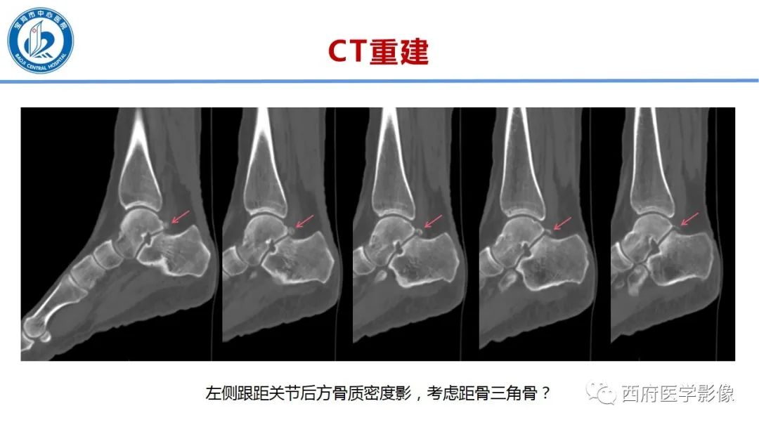 影像PPT - 【PPT】距后三角籽骨综合征影像诊断-1
