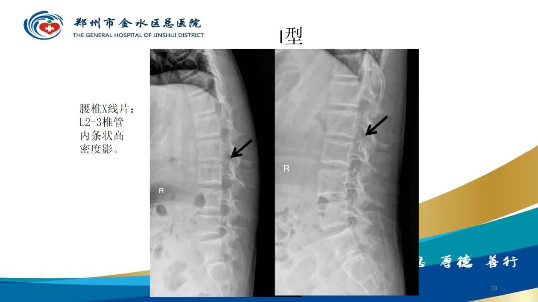 影像PPT - 【PPT】脊髓纵裂及相关疾病影像表现-10