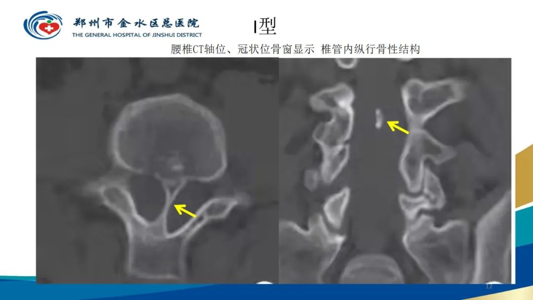 影像PPT - 【PPT】脊髓纵裂及相关疾病影像表现-12