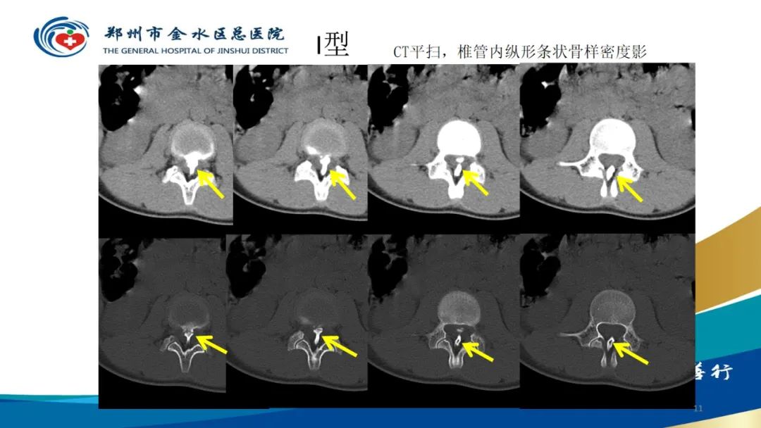 影像PPT - 【PPT】脊髓纵裂及相关疾病影像表现-11