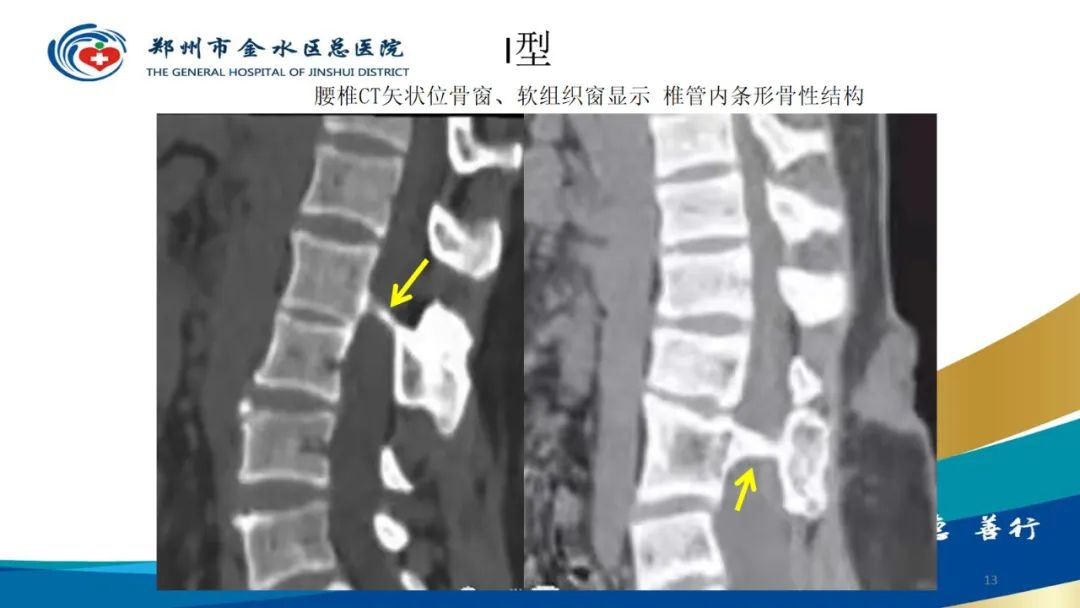 影像PPT - 【PPT】脊髓纵裂及相关疾病影像表现-13