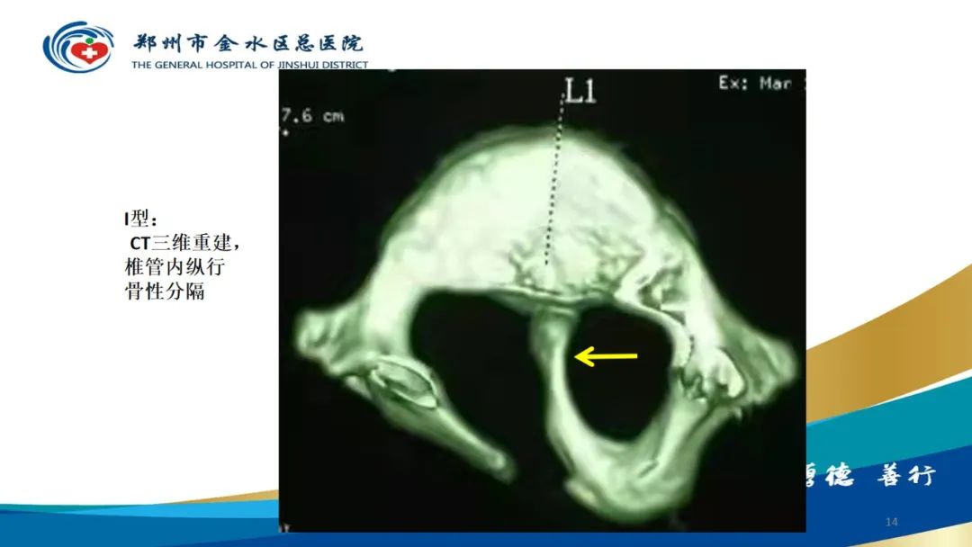 影像PPT - 【PPT】脊髓纵裂及相关疾病影像表现-14