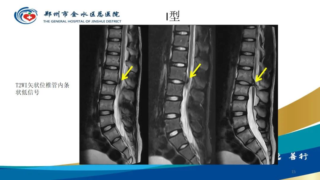 影像PPT - 【PPT】脊髓纵裂及相关疾病影像表现-15