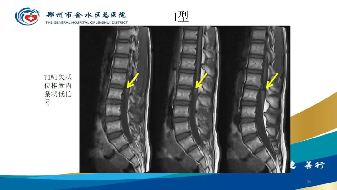 影像PPT - 【PPT】脊髓纵裂及相关疾病影像表现-16