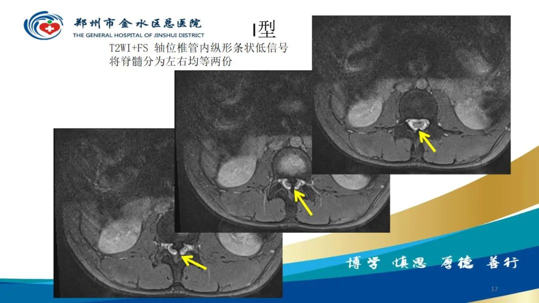 影像PPT - 【PPT】脊髓纵裂及相关疾病影像表现-17