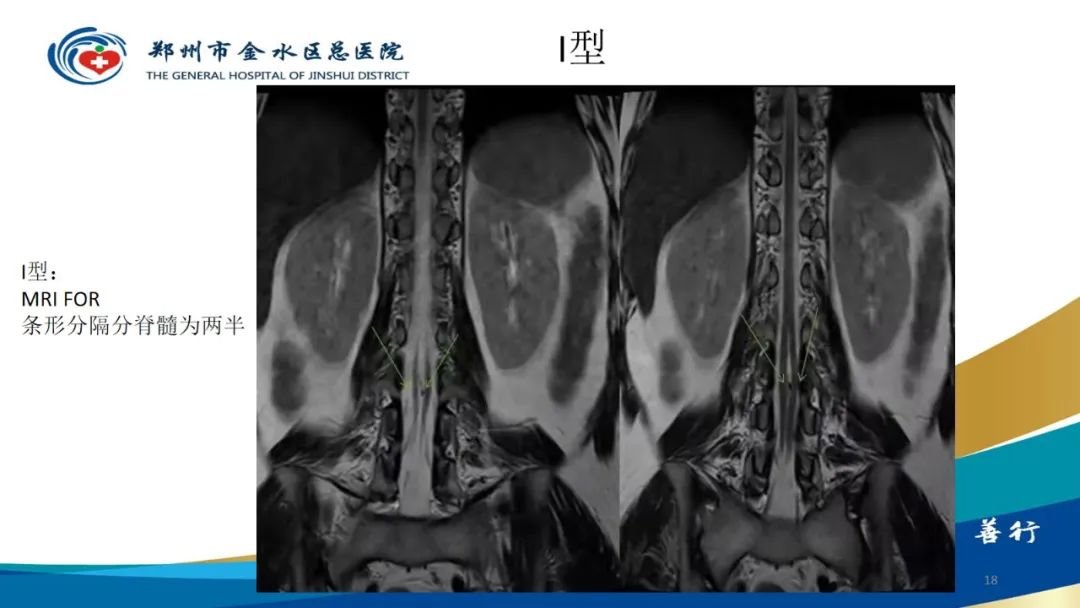 影像PPT - 【PPT】脊髓纵裂及相关疾病影像表现-18