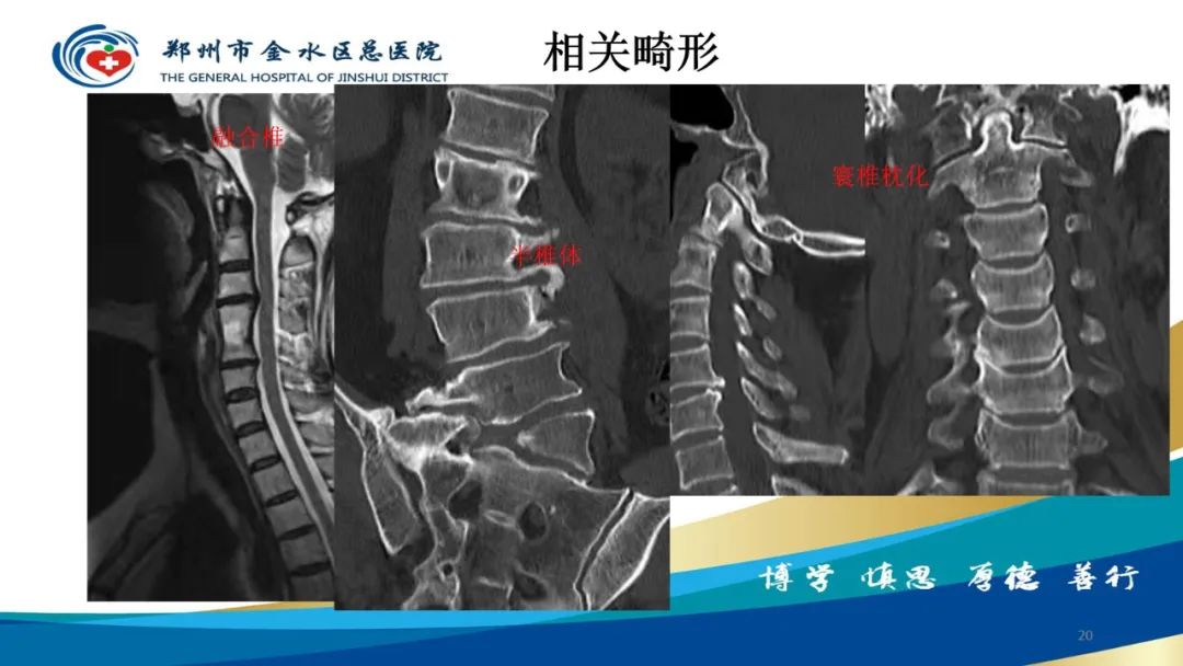 影像PPT - 【PPT】脊髓纵裂及相关疾病影像表现-20
