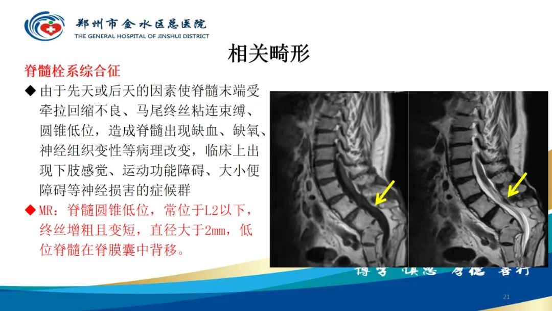 影像PPT - 【PPT】脊髓纵裂及相关疾病影像表现-21