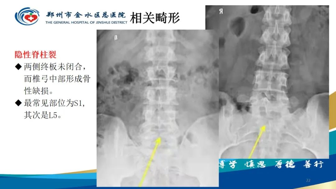 影像PPT - 【PPT】脊髓纵裂及相关疾病影像表现-22