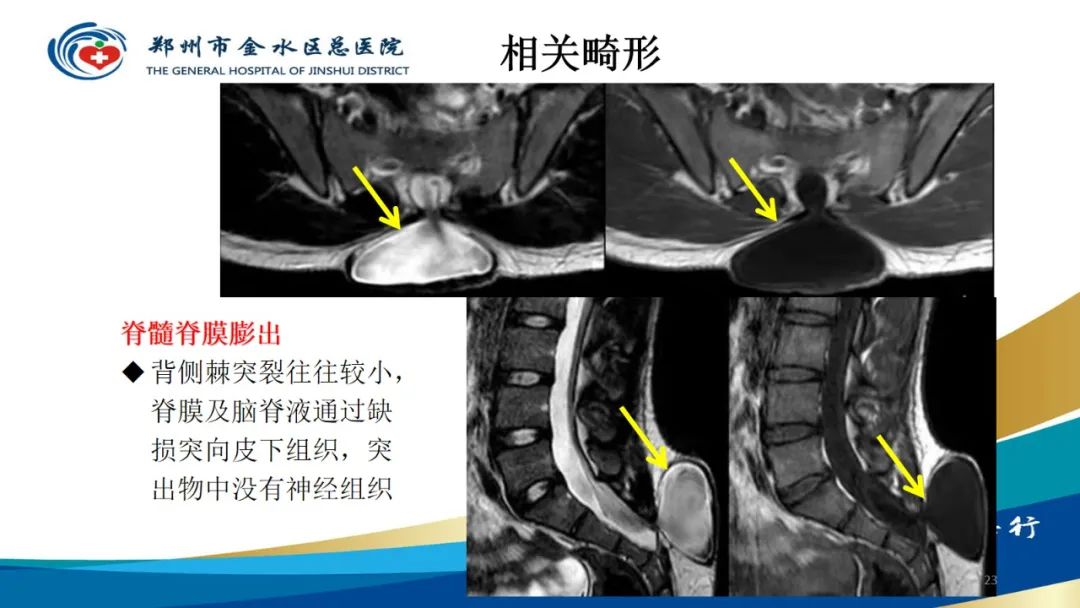 影像PPT - 【PPT】脊髓纵裂及相关疾病影像表现-23