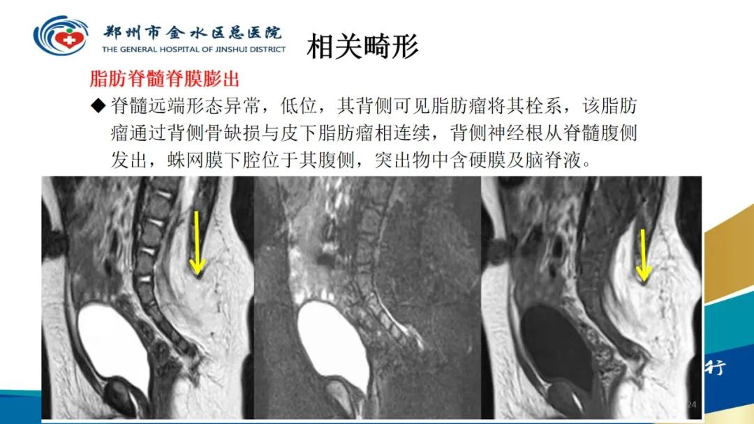 影像PPT - 【PPT】脊髓纵裂及相关疾病影像表现-24