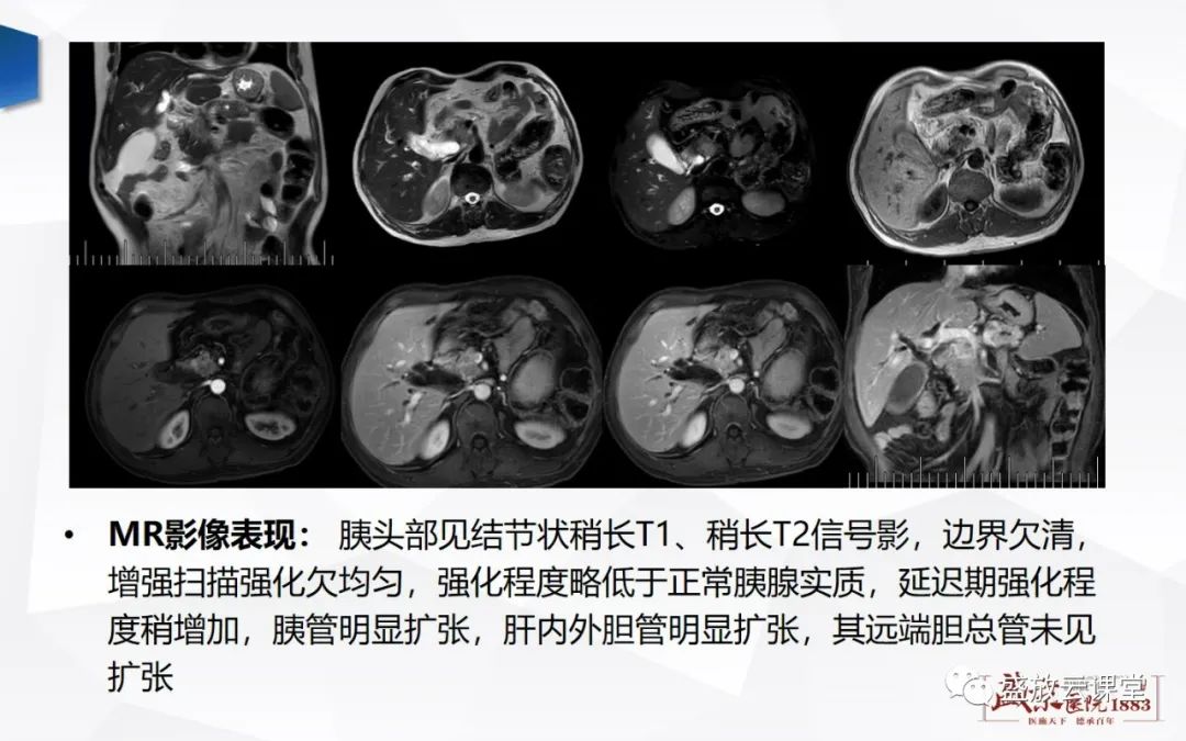 影像PPT - 【PPT】胰腺病变-胰腺癌-5