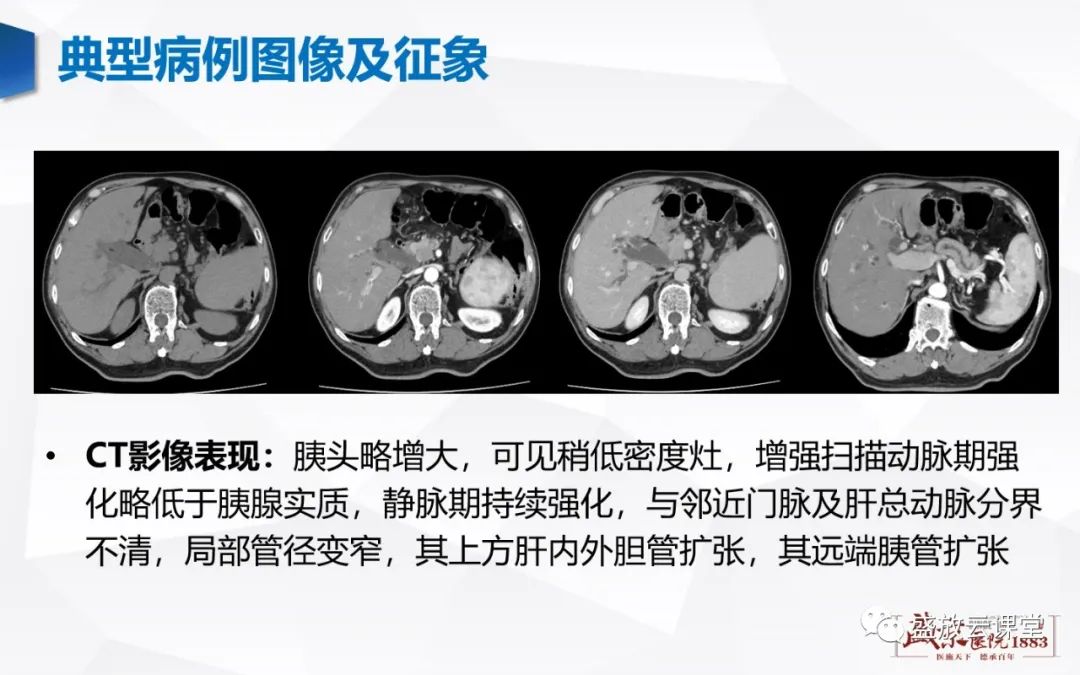 影像PPT - 【PPT】胰腺病变-胰腺癌-4