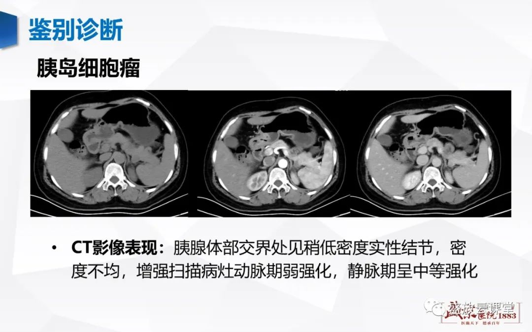 影像PPT - 【PPT】胰腺病变-胰腺癌-9
