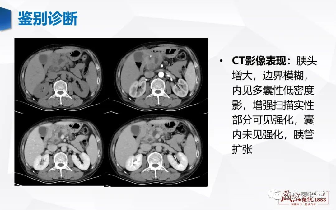 影像PPT - 【PPT】胰腺病变-胰腺癌-13