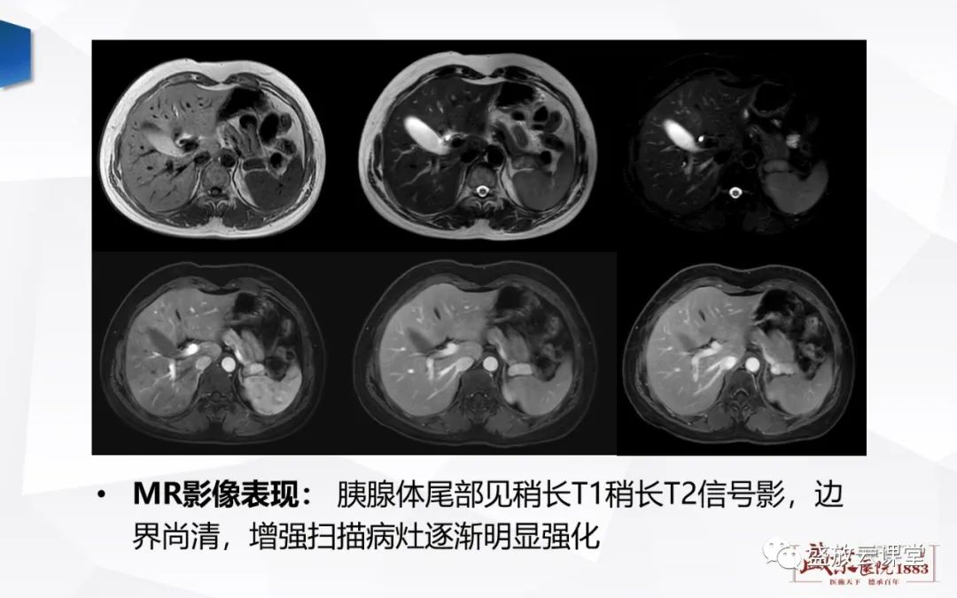 影像PPT - 【PPT】胰腺病变-胰腺癌-10