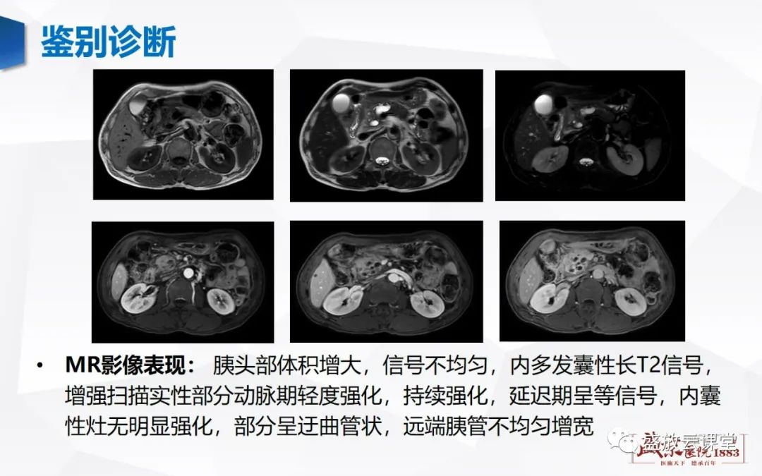 影像PPT - 【PPT】胰腺病变-胰腺癌-14