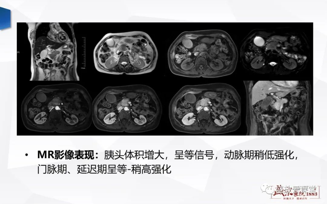 影像PPT - 【PPT】胰腺病变-胰腺癌-17