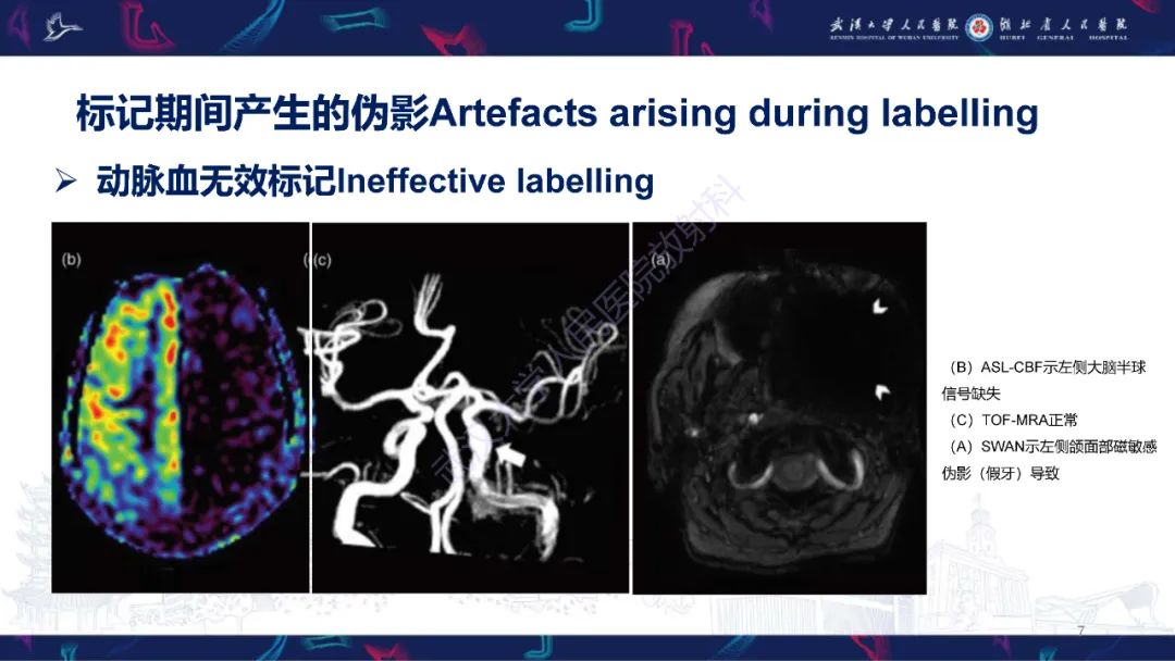 影像PPT - 【PPT】动脉自旋标记（ASL）伪影机制及图像解读-7