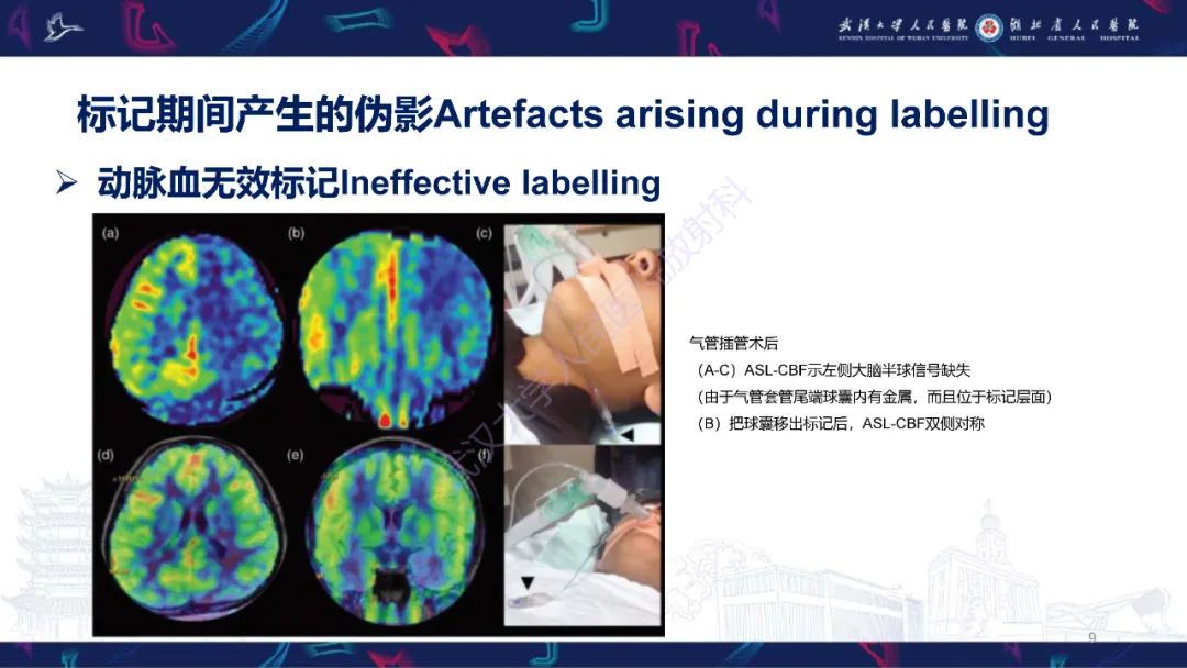 影像PPT - 【PPT】动脉自旋标记（ASL）伪影机制及图像解读-9
