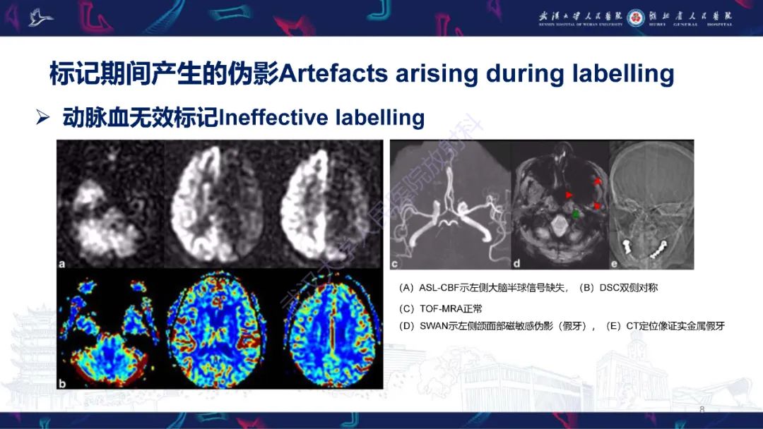 影像PPT - 【PPT】动脉自旋标记（ASL）伪影机制及图像解读-8