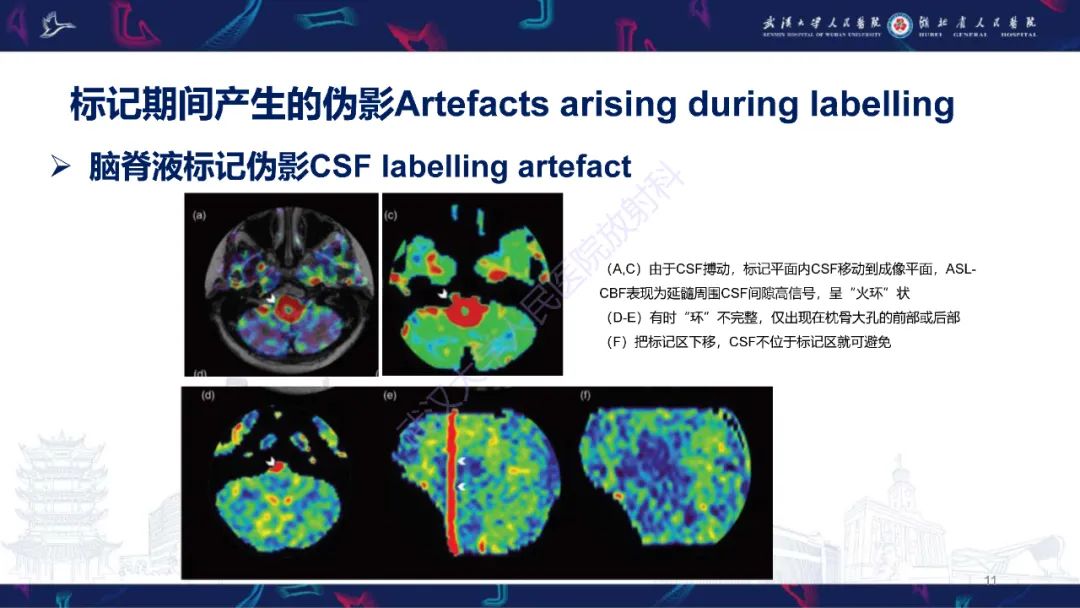 影像PPT - 【PPT】动脉自旋标记（ASL）伪影机制及图像解读-11