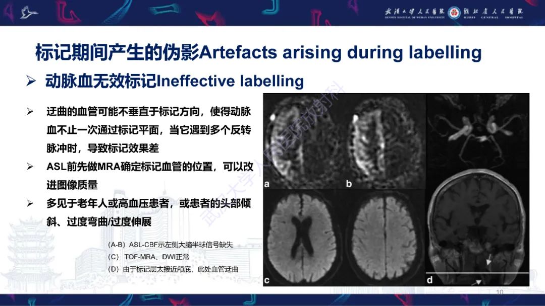 影像PPT - 【PPT】动脉自旋标记（ASL）伪影机制及图像解读-10