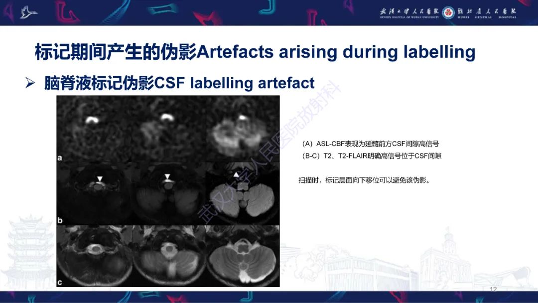 影像PPT - 【PPT】动脉自旋标记（ASL）伪影机制及图像解读-12