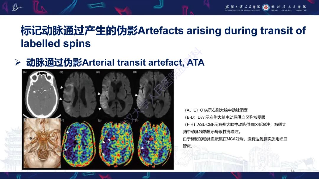 影像PPT - 【PPT】动脉自旋标记（ASL）伪影机制及图像解读-14