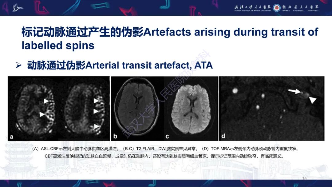 影像PPT - 【PPT】动脉自旋标记（ASL）伪影机制及图像解读-15