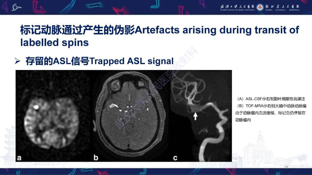 影像PPT - 【PPT】动脉自旋标记（ASL）伪影机制及图像解读-18