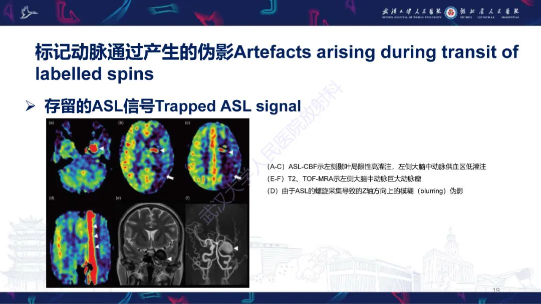影像PPT - 【PPT】动脉自旋标记（ASL）伪影机制及图像解读-19