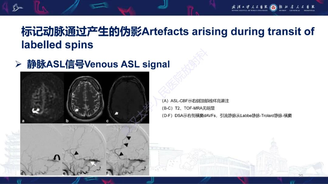 影像PPT - 【PPT】动脉自旋标记（ASL）伪影机制及图像解读-20