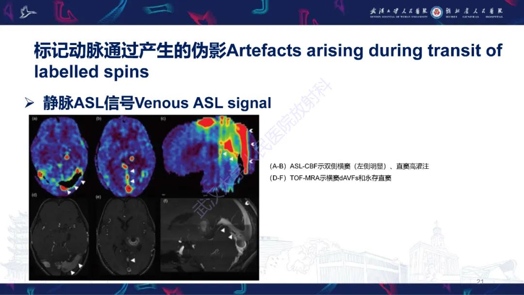 影像PPT - 【PPT】动脉自旋标记（ASL）伪影机制及图像解读-21