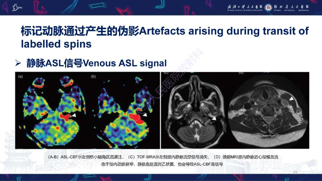 影像PPT - 【PPT】动脉自旋标记（ASL）伪影机制及图像解读-22