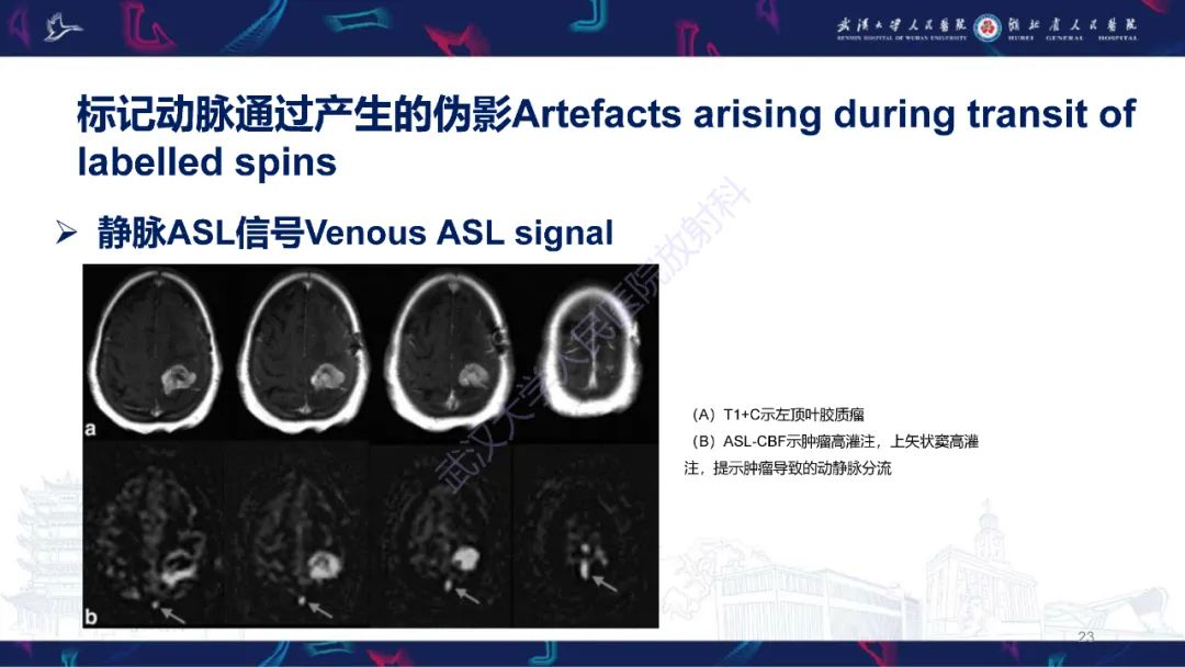 影像PPT - 【PPT】动脉自旋标记（ASL）伪影机制及图像解读-23