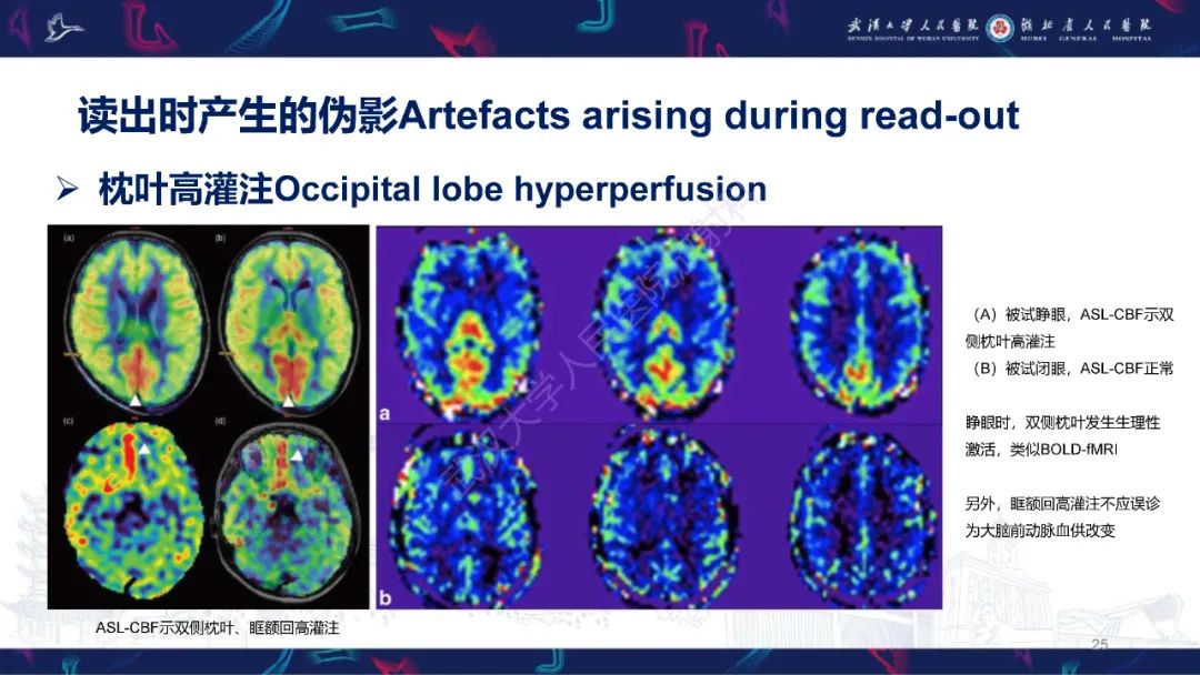 影像PPT - 【PPT】动脉自旋标记（ASL）伪影机制及图像解读-25