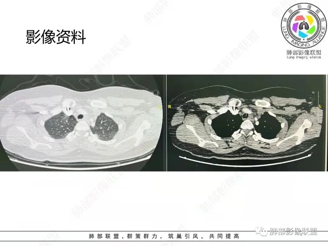 影像PPT - 【病例】肺结节病,一眼定乾坤!-4 影像PPT - 【病例】肺结节病,一眼定乾坤!-4