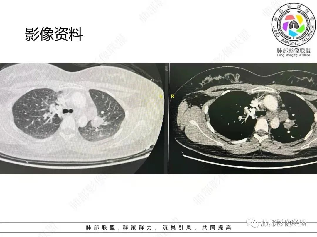 影像PPT - 【病例】肺结节病,一眼定乾坤!-7 影像PPT - 【病例】肺结节病,一眼定乾坤!-7