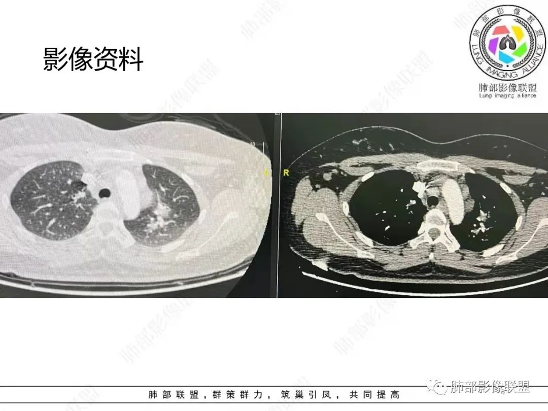 影像PPT - 【病例】肺结节病,一眼定乾坤!-6 影像PPT - 【病例】肺结节病,一眼定乾坤!-6