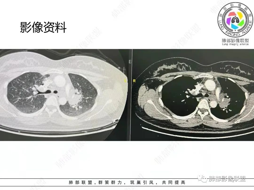 影像PPT - 【病例】肺结节病,一眼定乾坤!-8 影像PPT - 【病例】肺结节病,一眼定乾坤!-8