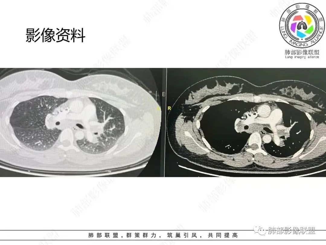 影像PPT - 【病例】肺结节病,一眼定乾坤!-11 影像PPT - 【病例】肺结节病,一眼定乾坤!-11