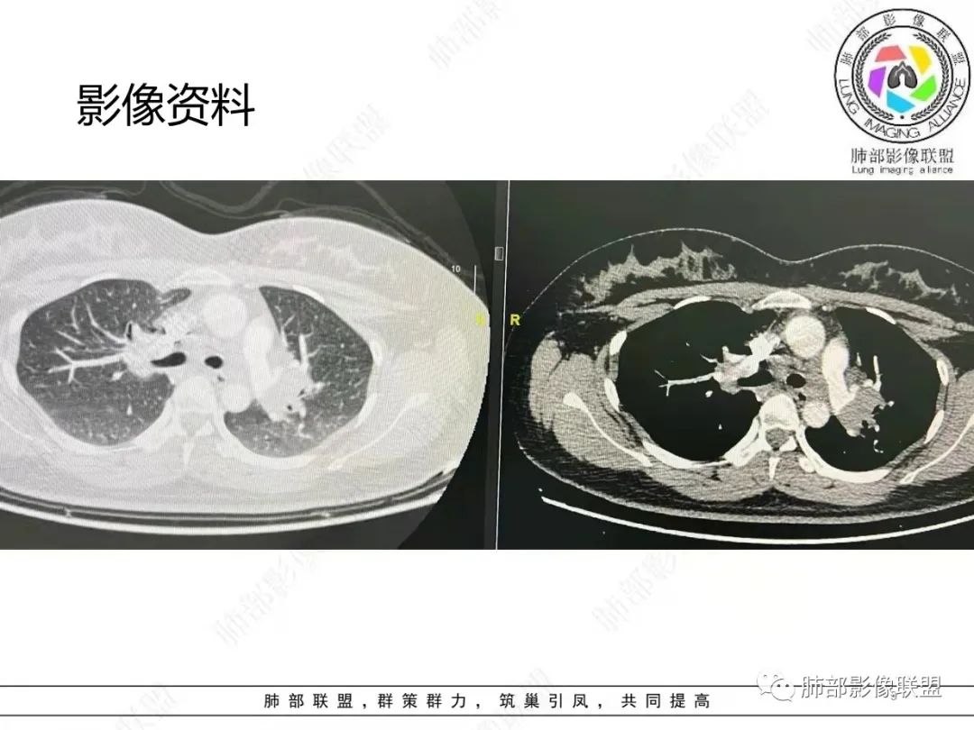 影像PPT - 【病例】肺结节病,一眼定乾坤!-9 影像PPT - 【病例】肺结节病,一眼定乾坤!-9