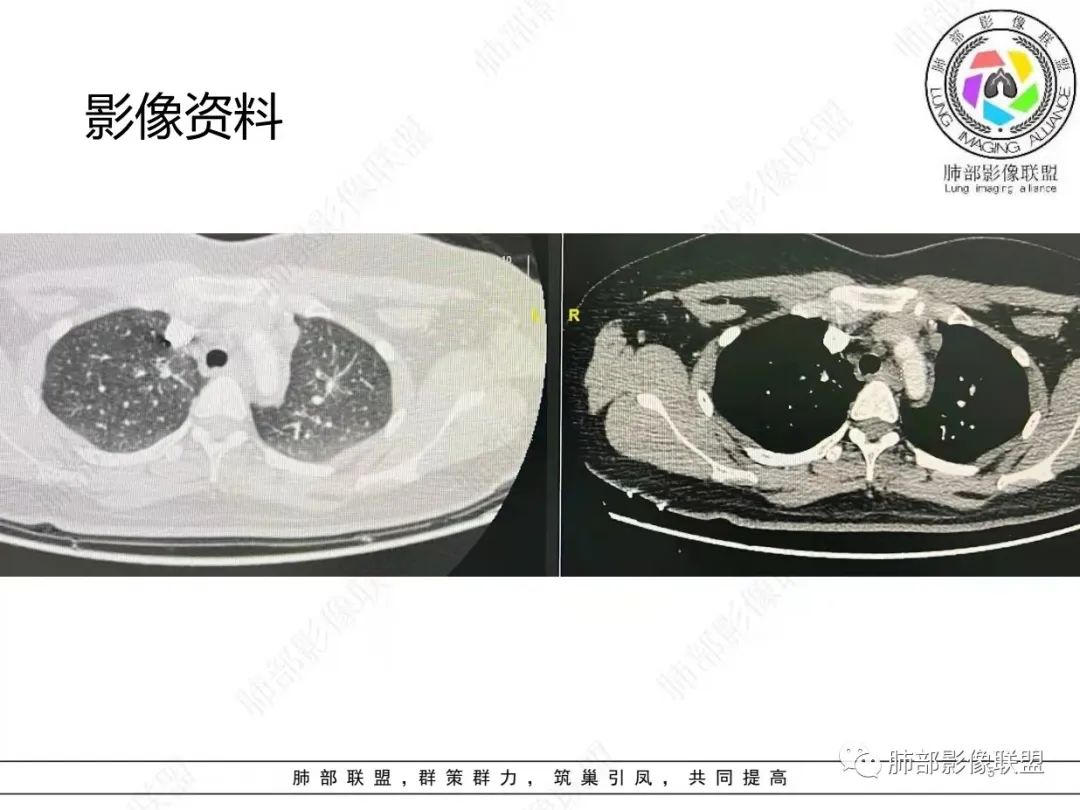 影像PPT - 【病例】肺结节病,一眼定乾坤!-5 影像PPT - 【病例】肺结节病,一眼定乾坤!-5